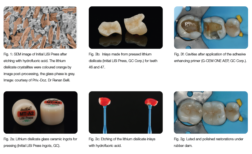 Process of restoration with lithium disilicate inlays